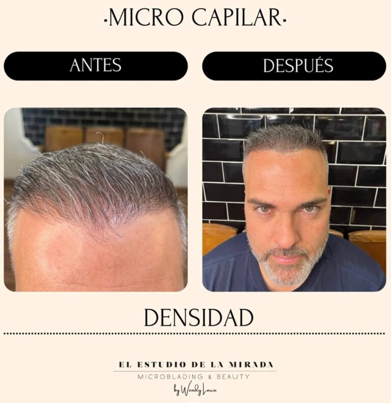 Micropigmentación capilar
